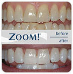 Отбеливание зубов Zoom-3