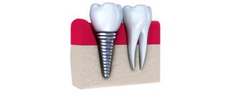 Имплантация зубов от клиники «Актуальная стоматология» – услуги, особенности и цены